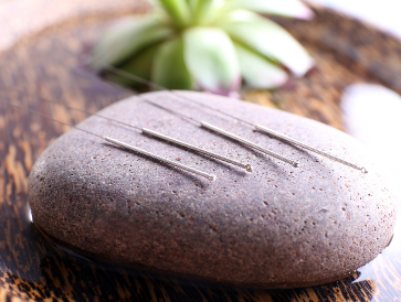 Treatment Acupuncture